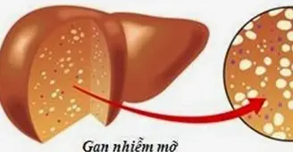 Bài thuốc chữa gan nhiễm mỡ từ dân gian - Khám Phá Giải Pháp Từ Thiên Nhiên Bài thuốc chữa gan nhiễm mỡ từ dân gian - Khám Phá Giải Pháp Từ Thiên Nhiên