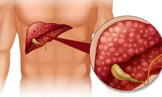 Bài thuốc chữa gan nhiễm mỡ từ dân gian - Khám Phá Giải Pháp Từ Thiên Nhiên Bài thuốc chữa gan nhiễm mỡ từ dân gian - Khám Phá Giải Pháp Từ Thiên Nhiên