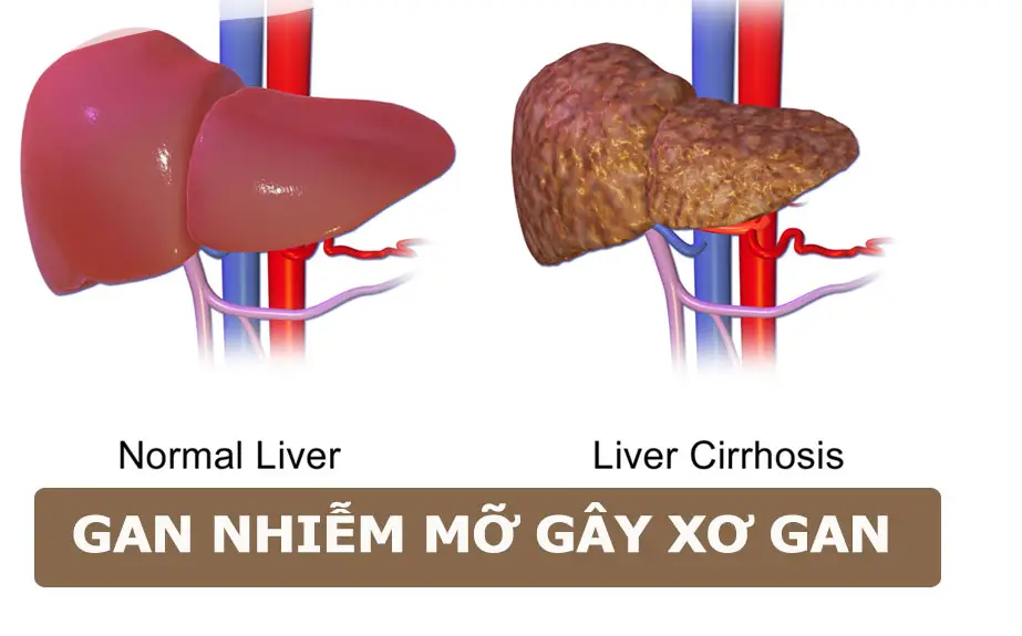 Bệnh gan nhiễm mỡ có chữa được không? Bệnh gan nhiễm mỡ có chữa được không?