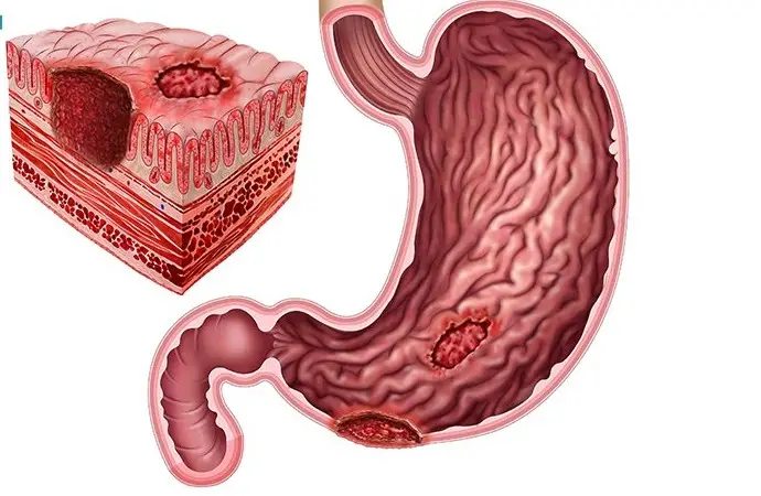Chữa đau dạ dày bằng nghệ có hiệu quả không? - Khám phá những tác dụng tuyệt vời