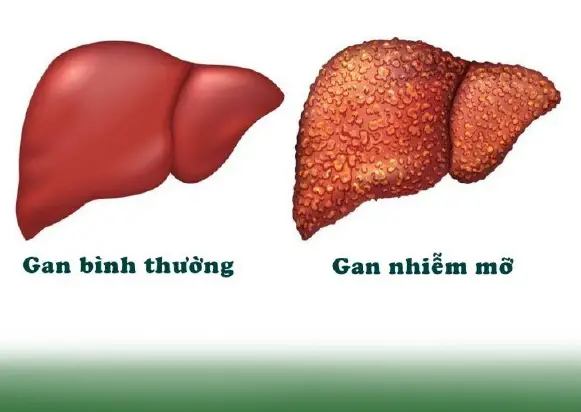 Hiểu đúng về gan nhiễm mỡ - Khám phá nguyên nhân, triệu chứng và biện pháp phòng ngừa hiệu quả