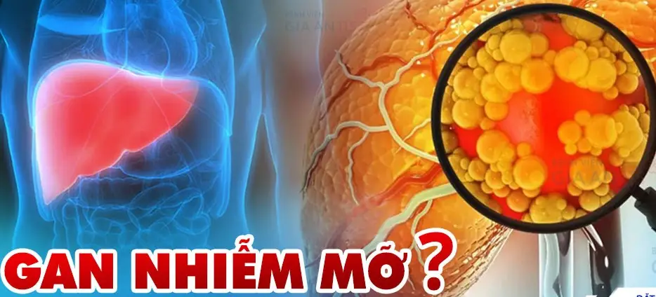 Người mắc bệnh gan nhiễm mỡ cần kiêng những gì?