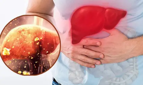 Người mắc bệnh gan nhiễm mỡ nên ăn gì?