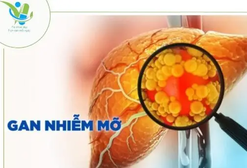 Người mắc bệnh gan nhiễm mỡ nên uống gì?