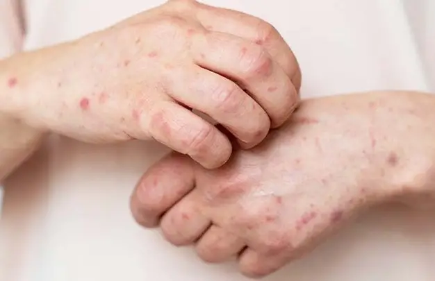 Nhóm người không nên ăn bắp cải Nhóm người không nên ăn bắp cải