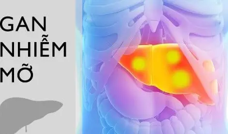 Triệu chứng của bệnh gan nhiễm mỡ
